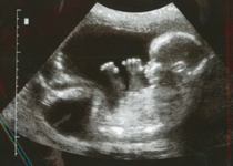 When Pro-Abortion Sentiments Trump Science and Common Sense